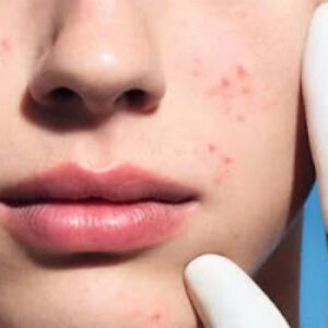 ACNE, emotional and spiritual meaning