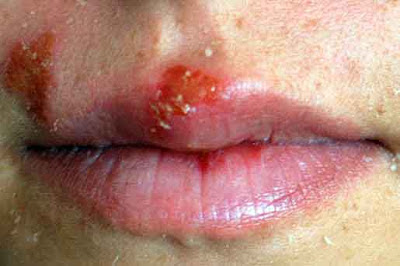 Read more about the article COLD SORES, emotional and spiritual meaning
