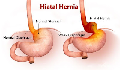 Read more about the article HIATAL HERNIA, emotional and spiritual meaning