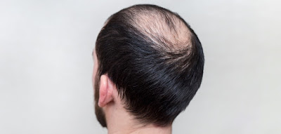 Read more about the article ALOPECIA, emotional and spiritual meaning