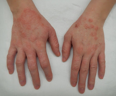 Read more about the article ECZEMA OR ATOPIC DERMATITIS, emotional and spiritual meaning