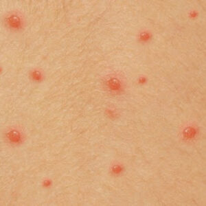 CHICKEN POX, emotional and spiritual meaning