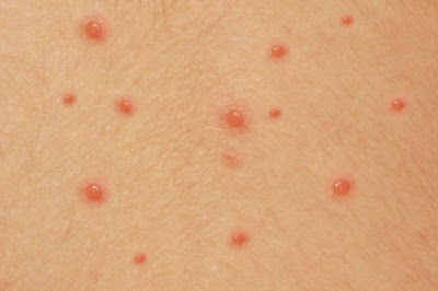 Read more about the article CHICKEN POX, emotional and spiritual meaning