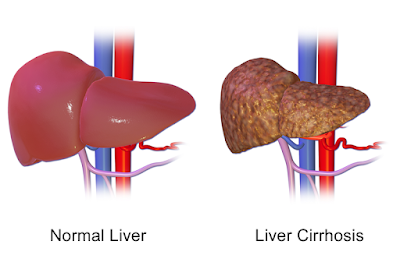 Read more about the article CIRRHOSIS, emotional and spiritual meaning