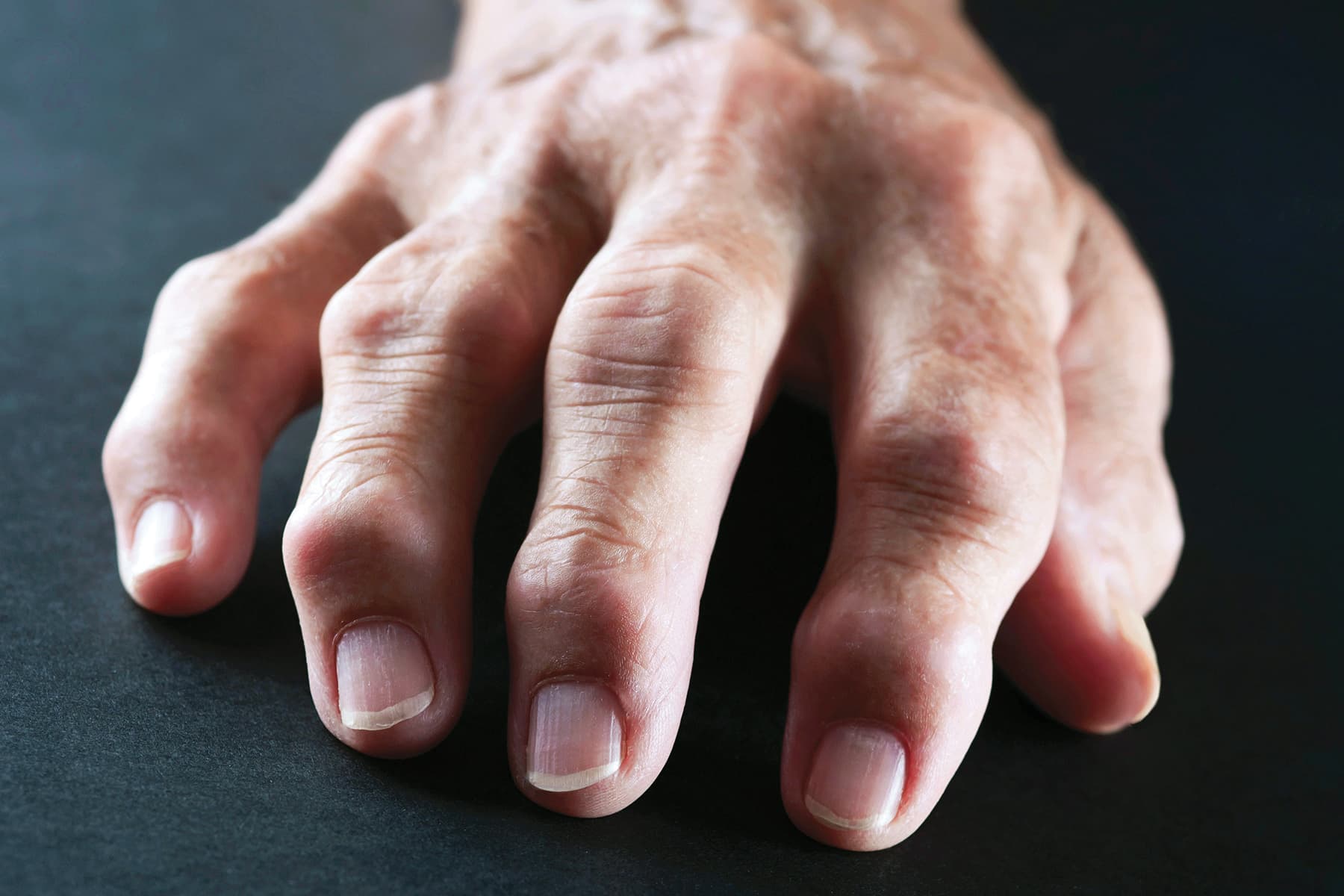 Read more about the article RHEUMATOID ARTHRITIS, emotional and spiritual meaning