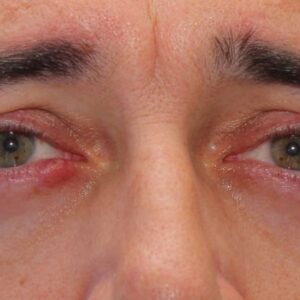 CHALAZION, emotional and spiritual meaning