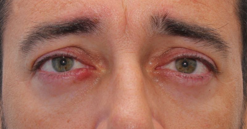 Read more about the article CHALAZION, emotional and spiritual meaning