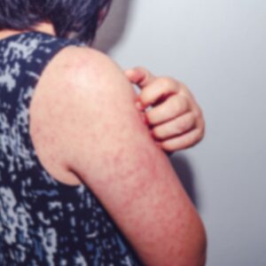 URTICARIA OR HIVES, emotional and spiritual meaning