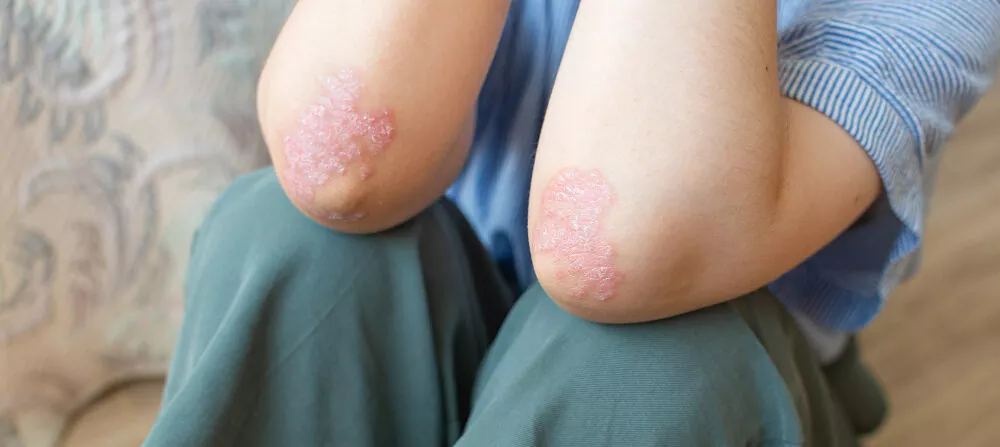PSORIASIS, emotional and spiritual meaning