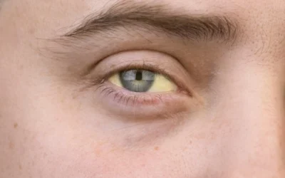 JAUNDICE, emotional and spiritual meaning