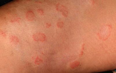 MYCOSIS, emotional and spiritual meaning