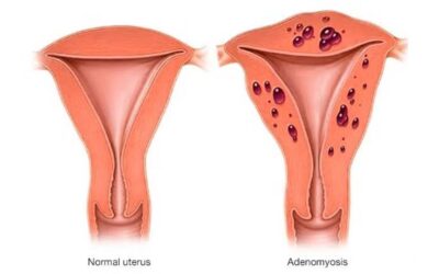 ADENOMYOSIS: Emotional and Spiritual Meaning