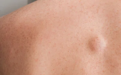 LIPOMA, Emotional and Spiritual Meaning
