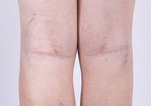 SPIDER VEINS on the legs: Emotional and Spiritual Meaning