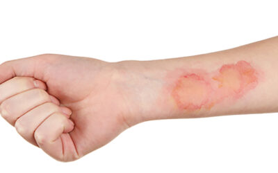 BURNS, emotional and spiritual meaning