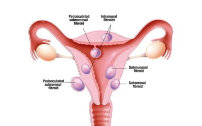 TYPE of FIBROID, emotional and spiritual meaning