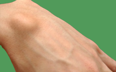 Ganglion in the wrist: emotional and spiritual meaning