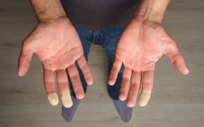 SCLERODERMA, emotional and spiritual meaning
